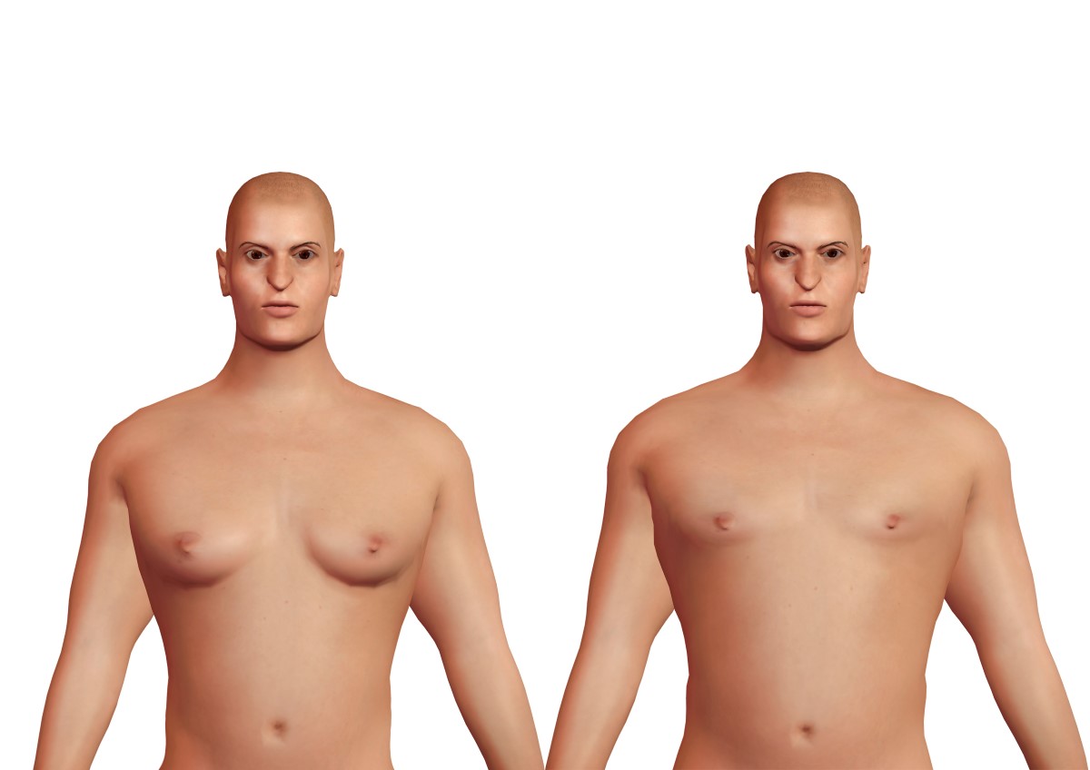 Gynekomastie a fyziologická prsa u muže